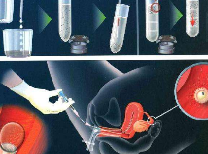 最低价格代怀:输卵管切除能做试管婴儿吗？